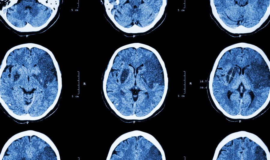 Traumatic Brain Injury Diagnosis Rates and Their Influence on Case Valuation